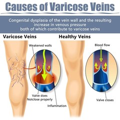 36PCS Varicose Veins Patch – Natural Relief Treatment for Legs, Spider