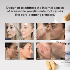 CLEARSTEM – MINDBODYSKIN Hormonal Acne Supplement 180 Count (Pack of 2)