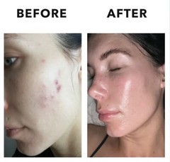 MINDBODYSKIN® Hormonal Acne Supplement 90 Capsules
