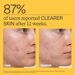 Nutrafol Clear Skin Acne Supplement for Women 1 Month Supply, Expiry Date 05/26