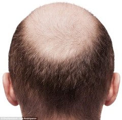 hair growth vitamins – DHT BLOCKER HAIR FORMULA – saw palmetto for hair loss 3B